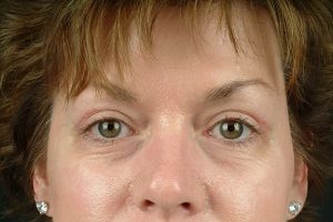 Blepharoplasty (Eyelid Surgery)