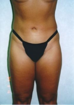 Liposuction