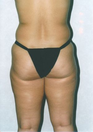 Liposuction