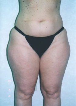 Liposuction