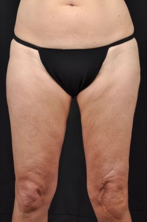 Liposuction