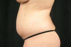 Liposuction