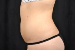 Liposuction