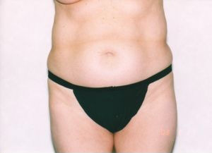 Liposuction