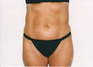 Liposuction