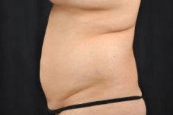 Liposuction