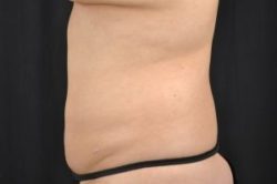 Liposuction