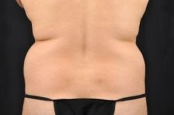 Liposuction