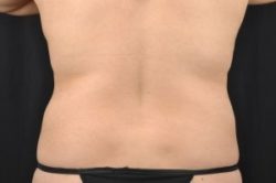 Liposuction