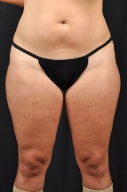 Liposuction