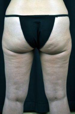 Liposuction