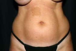 Liposuction