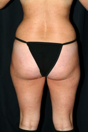 Liposuction