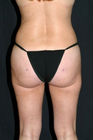 Liposuction