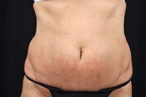 Liposuction