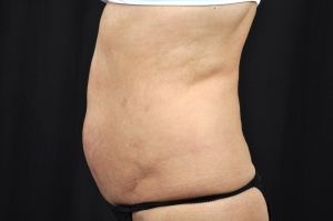 Liposuction