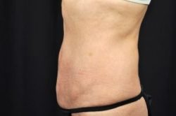 Liposuction