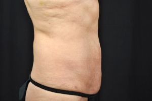 Liposuction