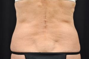 Liposuction