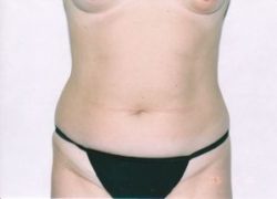 Liposuction