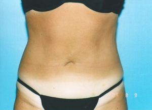 Liposuction