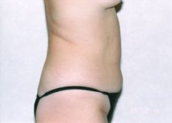 Liposuction