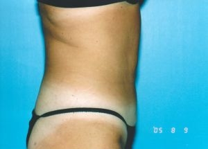 Liposuction