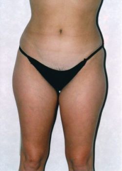 Liposuction