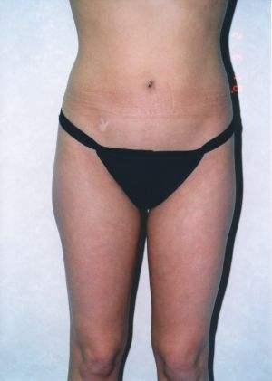 Liposuction