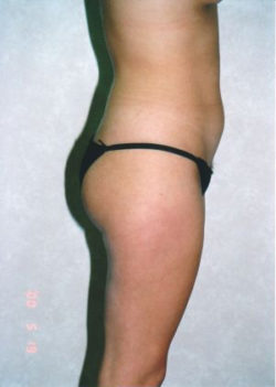 Liposuction