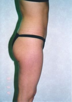 Liposuction