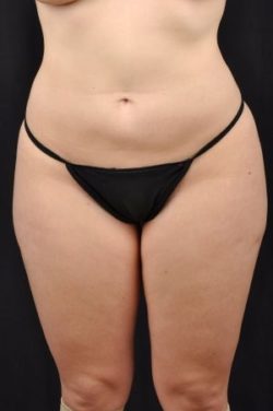 Liposuction