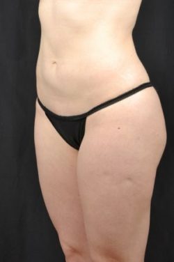 Liposuction