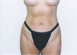 Liposuction