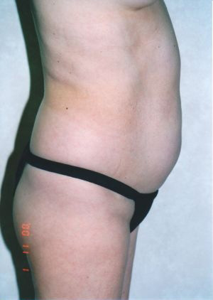 Liposuction