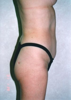 Liposuction