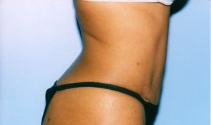 Tummy Tuck