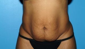 Tummy Tuck