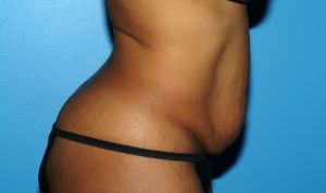 Tummy Tuck