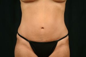 Tummy Tuck