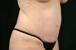 Tummy Tuck