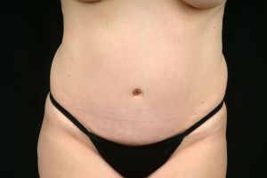 Tummy Tuck