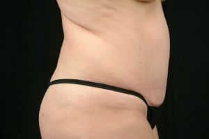 Tummy Tuck