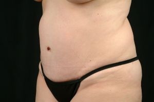 Tummy Tuck