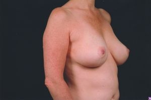 Breast Lift