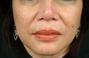 Injectable Fillers