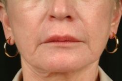Injectable Fillers