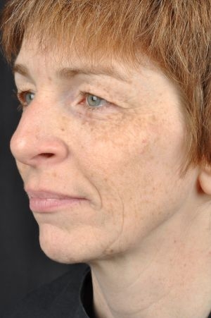 Laser Skin Rejuvenation