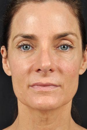 Laser Skin Rejuvenation