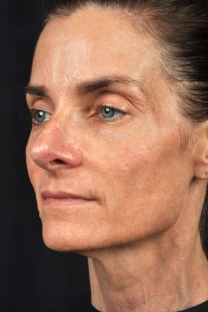 Laser Skin Rejuvenation